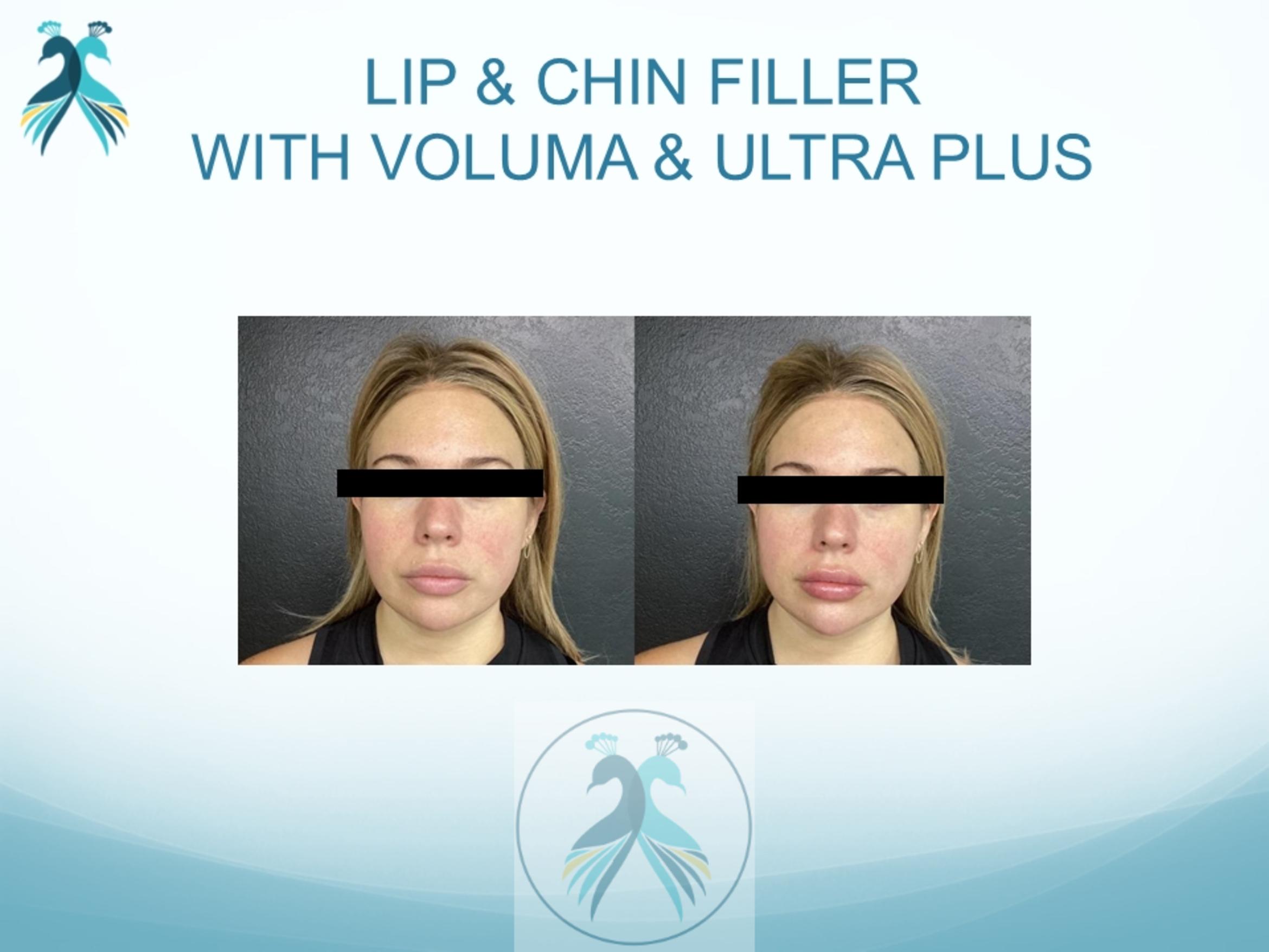 Before & After JUVÉDERM® Dermal Fillers Case 19 View 1 View in The Woodlands, TX