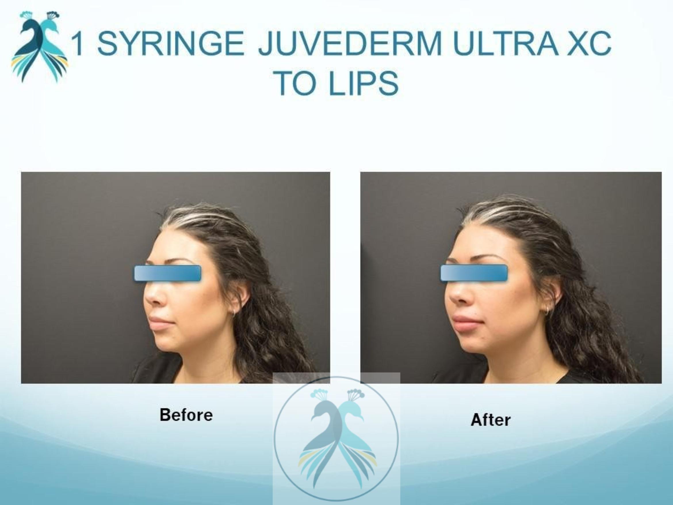 Before & After JUVÉDERM® Dermal Fillers Case 20 View 1 View in The Woodlands, TX