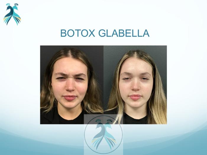 Before & After BOTOX® Cosmetic Case 1 View 1 View in The Woodlands, TX