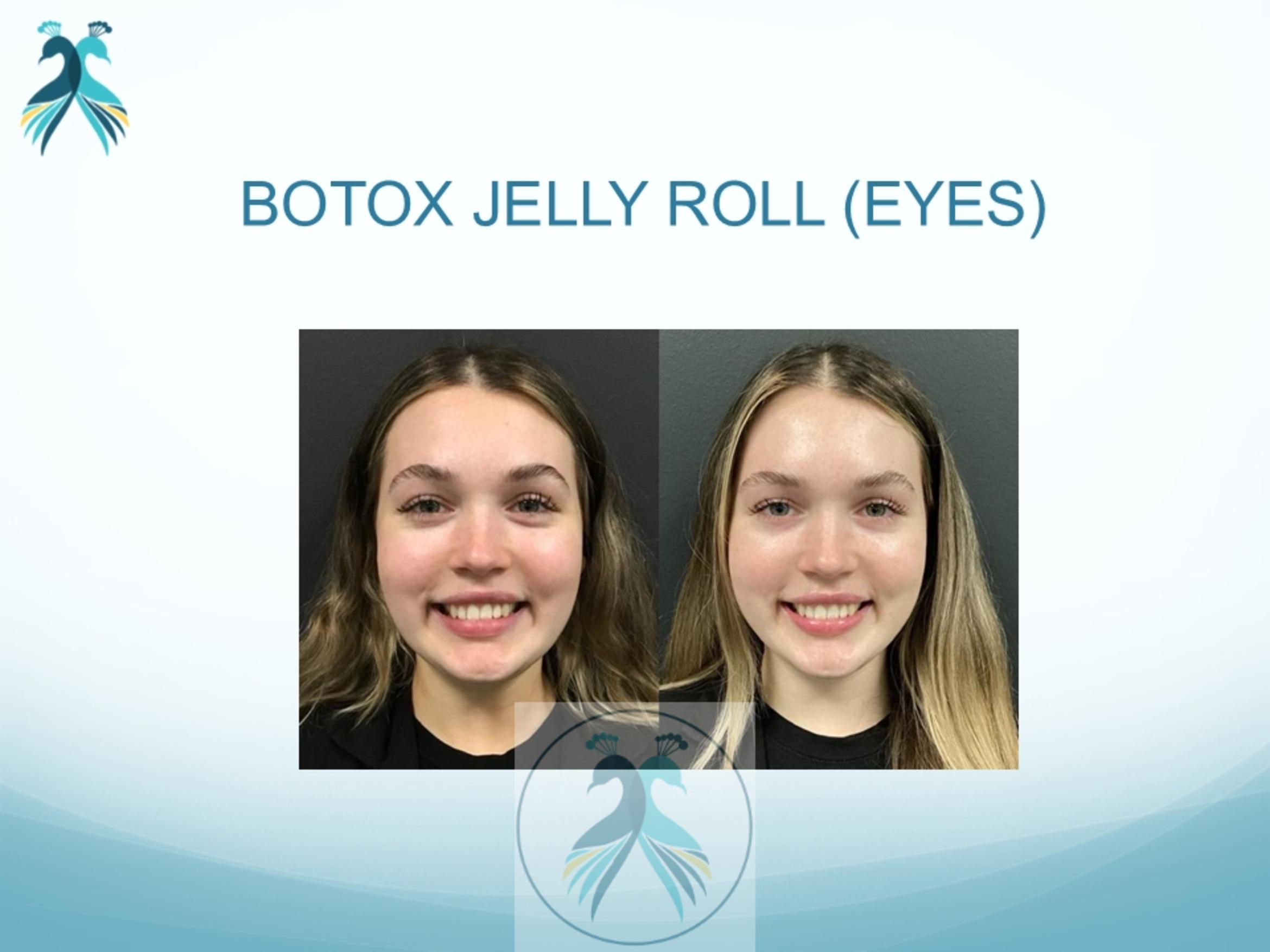 Before & After BOTOX® Cosmetic Case 2 View 1 View in The Woodlands, TX
