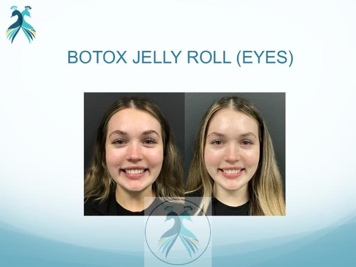 Before & After BOTOX® Cosmetic Case 2 View 1 View in The Woodlands, TX