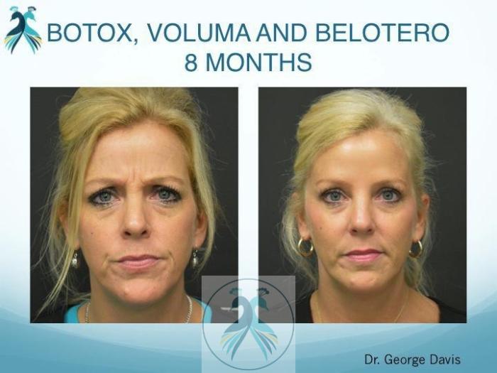 Before & After BOTOX® Cosmetic Case 4 View 1 View in The Woodlands, TX