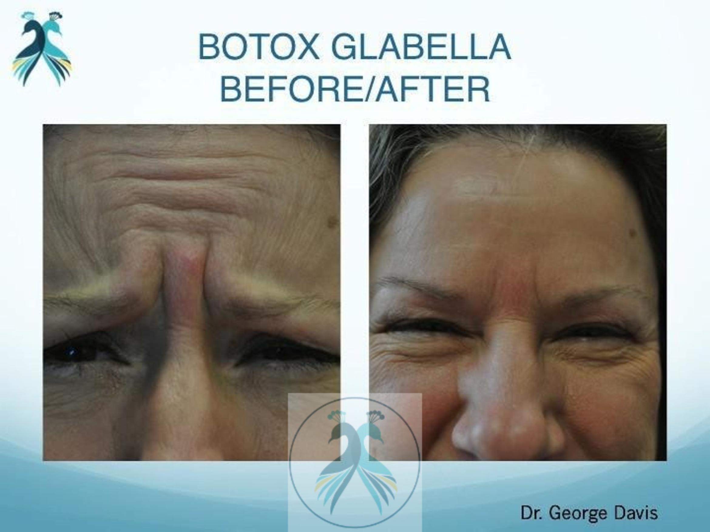 Before & After BOTOX® Cosmetic Case 5 View 1 View in The Woodlands, TX