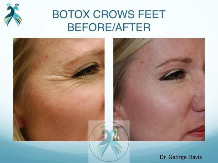 Before & After BOTOX® Cosmetic Case 6 View 1 View in The Woodlands, TX