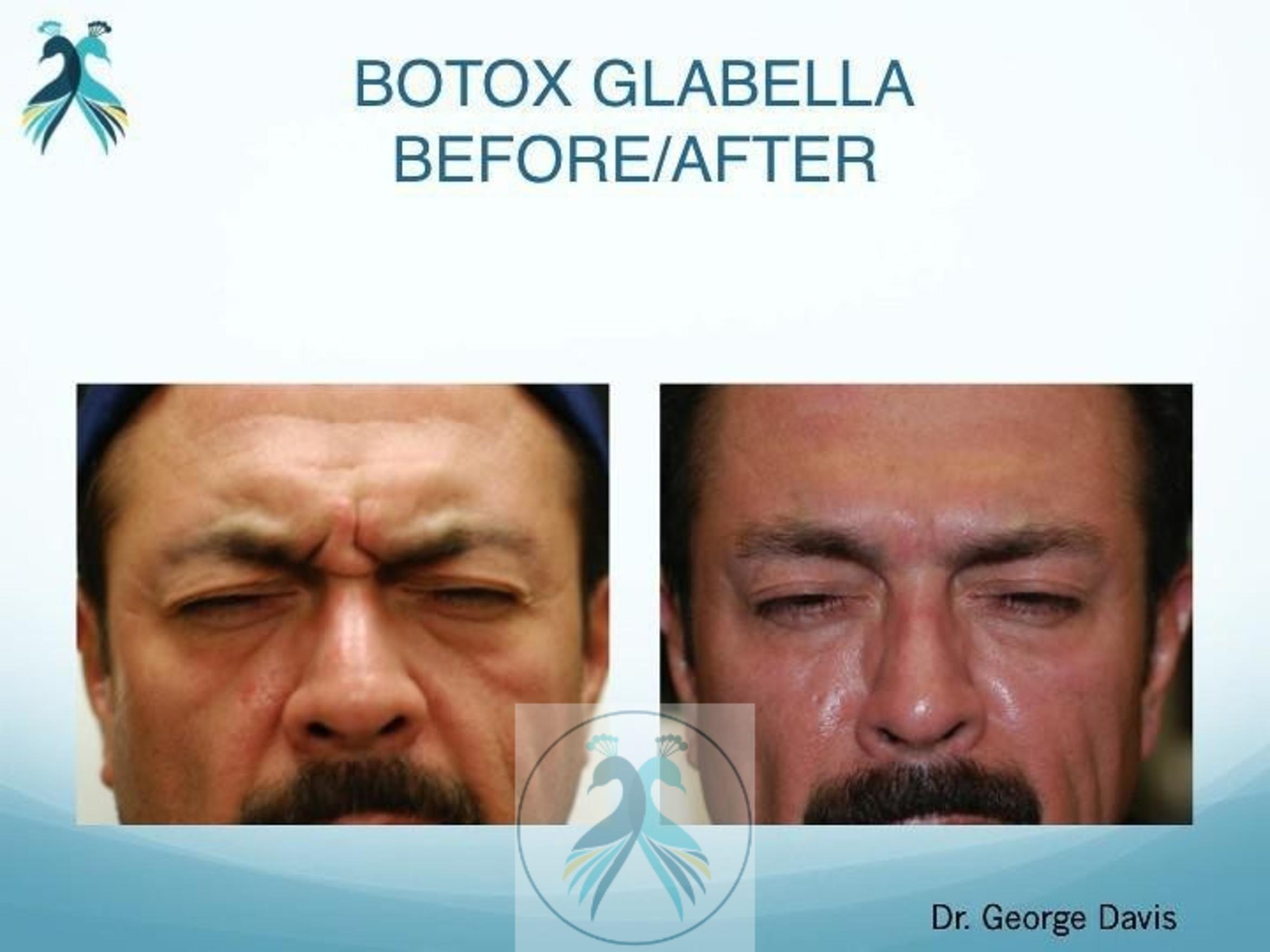Before & After BOTOX® Cosmetic Case 7 View 1 View in The Woodlands, TX