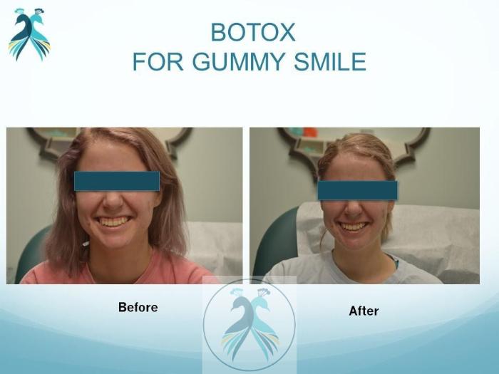 Before & After BOTOX® Cosmetic Case 8 View 1 View in The Woodlands, TX