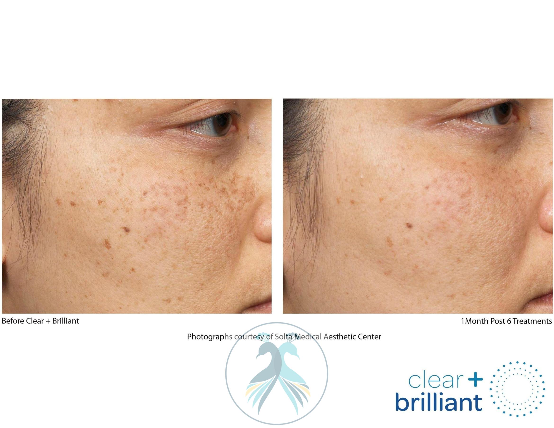 Before & After Clear + Brilliant® Case 11 View 1 View in The Woodlands, TX