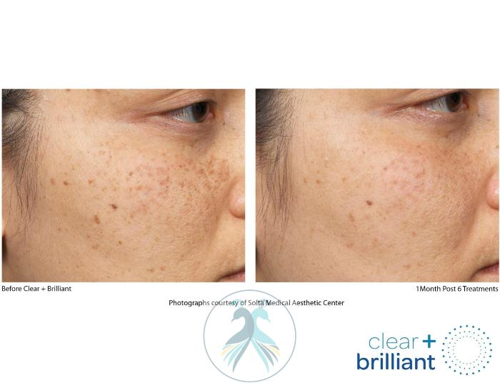 Before & After Clear + Brilliant® Case 11 View 1 View in The Woodlands, TX