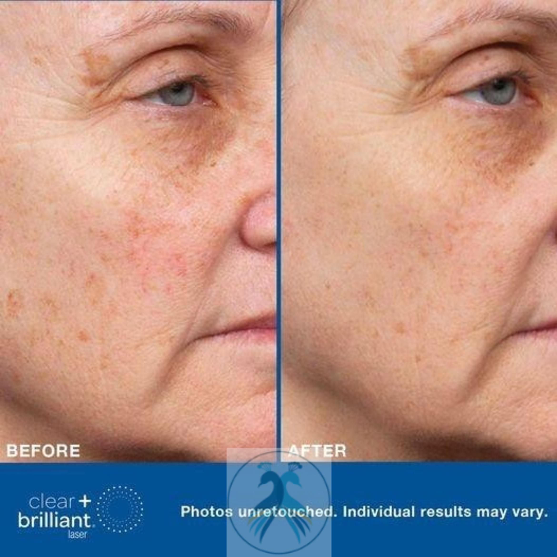 Before & After Clear + Brilliant® Case 12 View 1 View in The Woodlands, TX