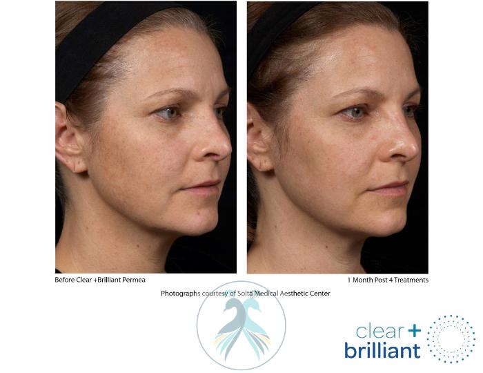 Before & After Clear + Brilliant® Case 9 View 1 View in The Woodlands, TX