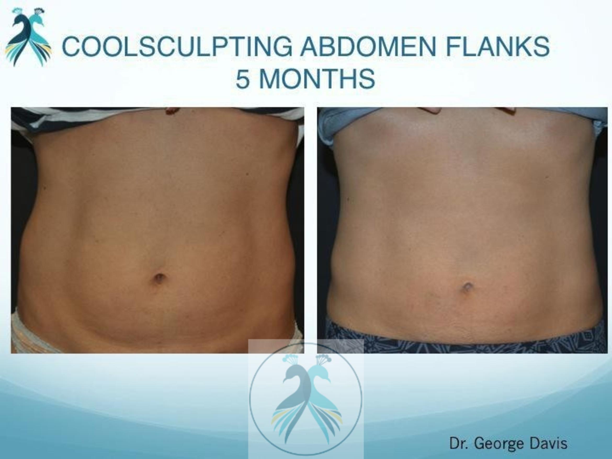 Before & After CoolSculpting® Elite Body Contouring Case 13 View 1 View in The Woodlands, TX