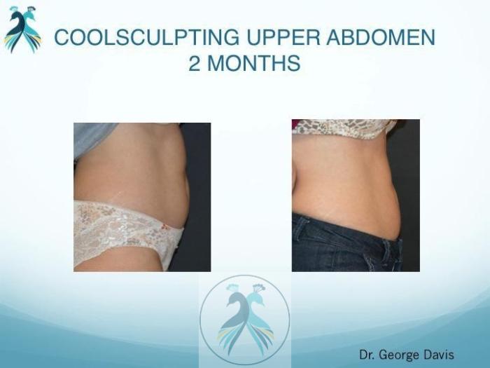 Before & After CoolSculpting® Elite Body Contouring Case 14 View 1 View in The Woodlands, TX