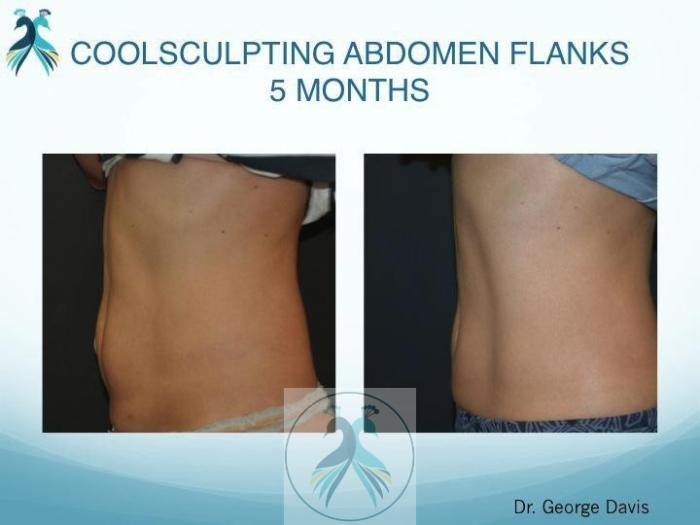 Before & After CoolSculpting® Elite Body Contouring Case 15 View 1 View in The Woodlands, TX