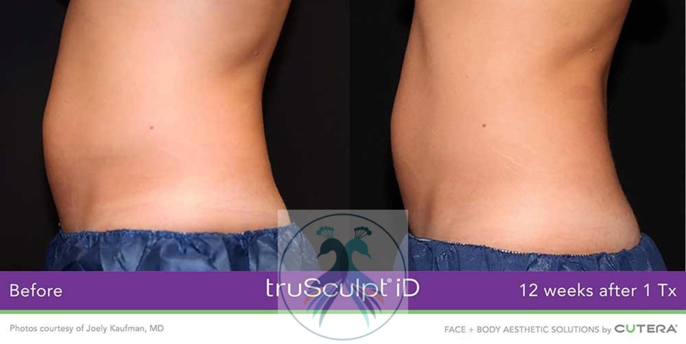 Before & After Fat Reduction with TruSculpt® Case 56 View 1 View in The Woodlands, TX