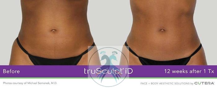 Before & After Fat Reduction with TruSculpt® Case 57 View 1 View in The Woodlands, TX