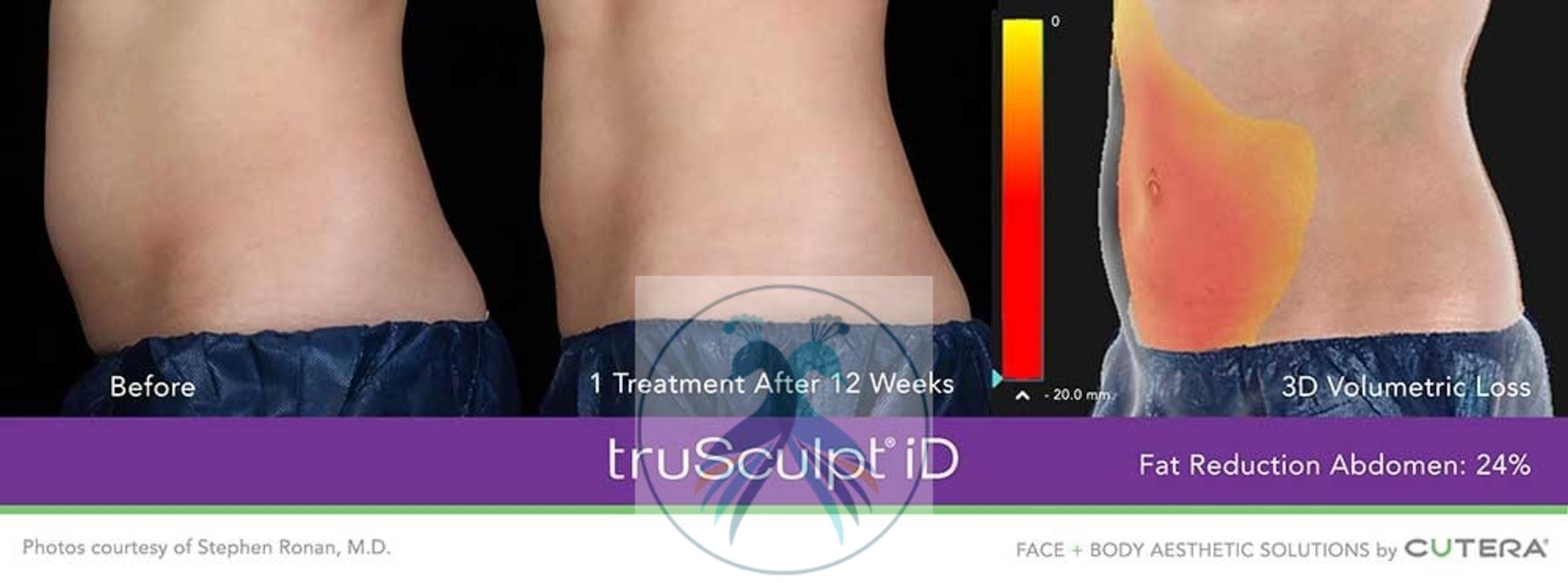 Before & After Fat Reduction with TruSculpt® Case 58 View 1 View in The Woodlands, TX