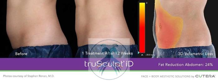 Before & After Fat Reduction with TruSculpt® Case 58 View 1 View in The Woodlands, TX