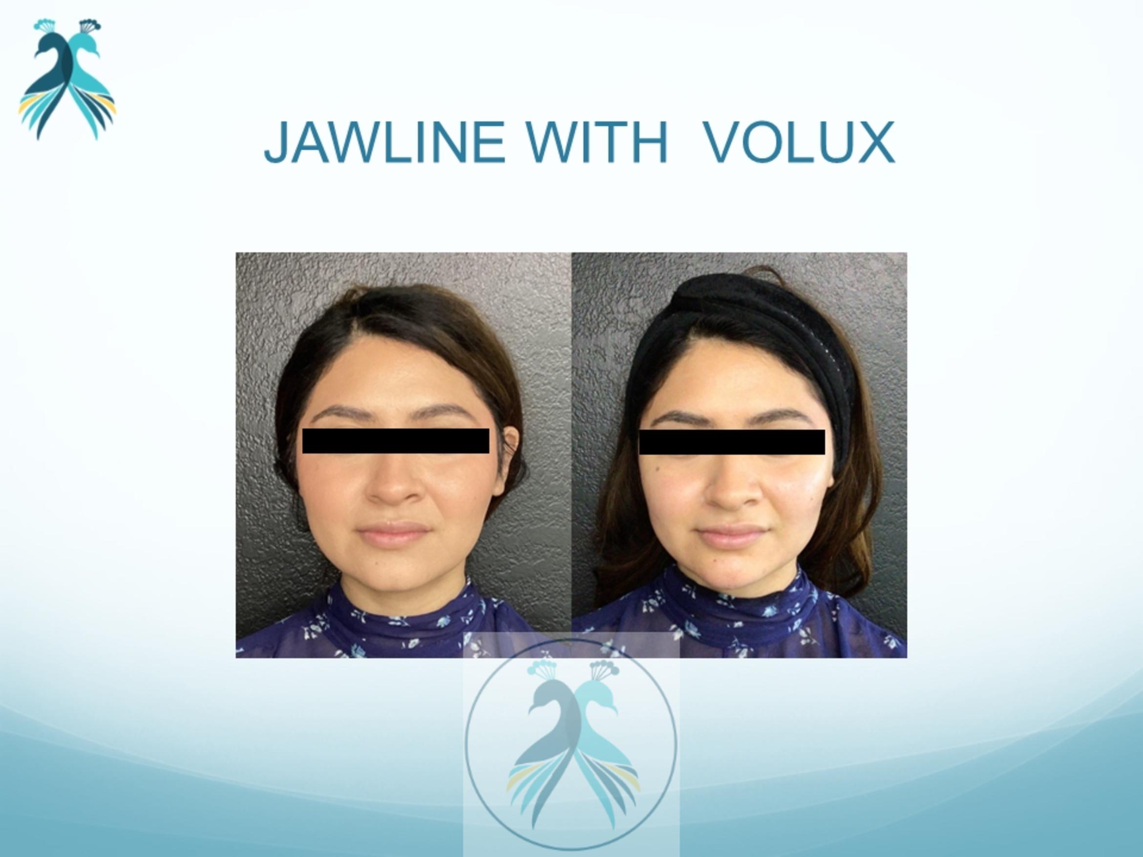 Before & After JUVÉDERM® Dermal Fillers Case 18 View 1 View in The Woodlands, TX