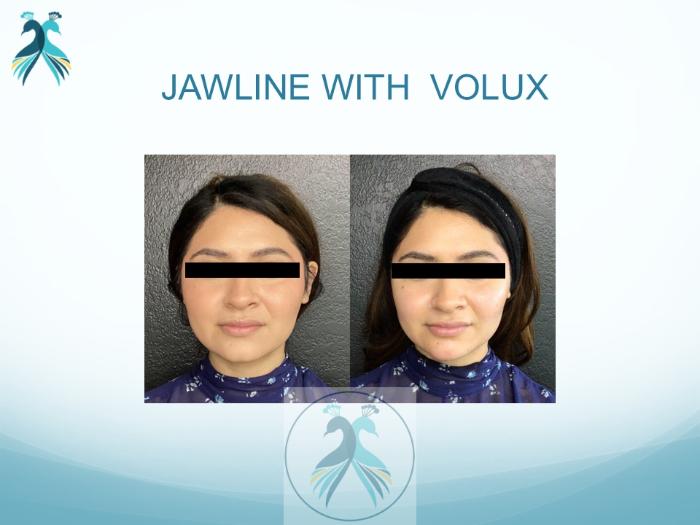 Before & After JUVÉDERM® Dermal Fillers Case 18 View 1 View in The Woodlands, TX