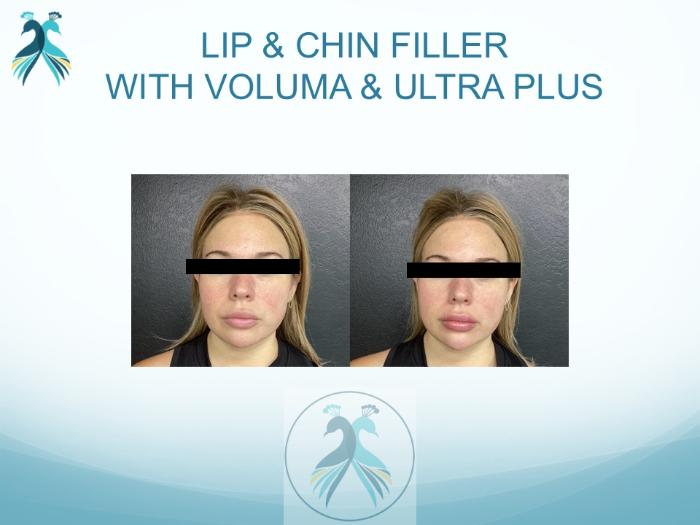 Before & After JUVÉDERM® Dermal Fillers Case 19 View 1 View in The Woodlands, TX
