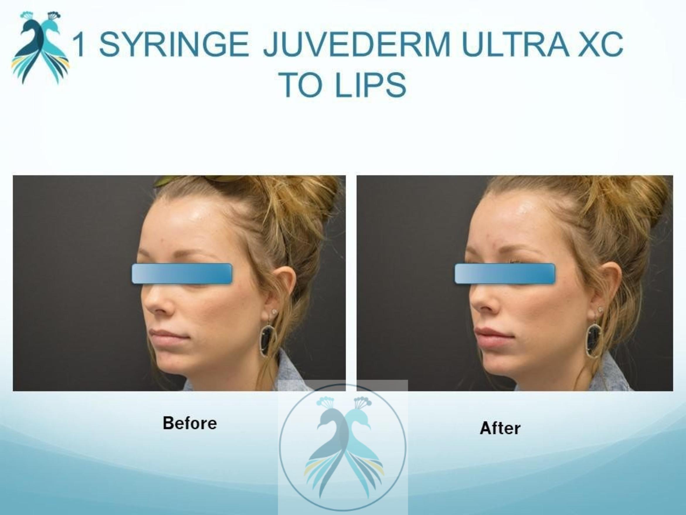 Before & After JUVÉDERM® Dermal Fillers Case 21 View 1 View in The Woodlands, TX