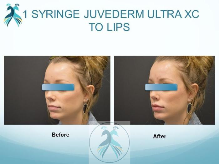 Before & After JUVÉDERM® Dermal Fillers Case 21 View 1 View in The Woodlands, TX