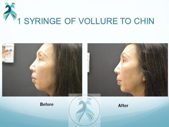 Before & After JUVÉDERM® Dermal Fillers Case 22 View 1 View in The Woodlands, TX