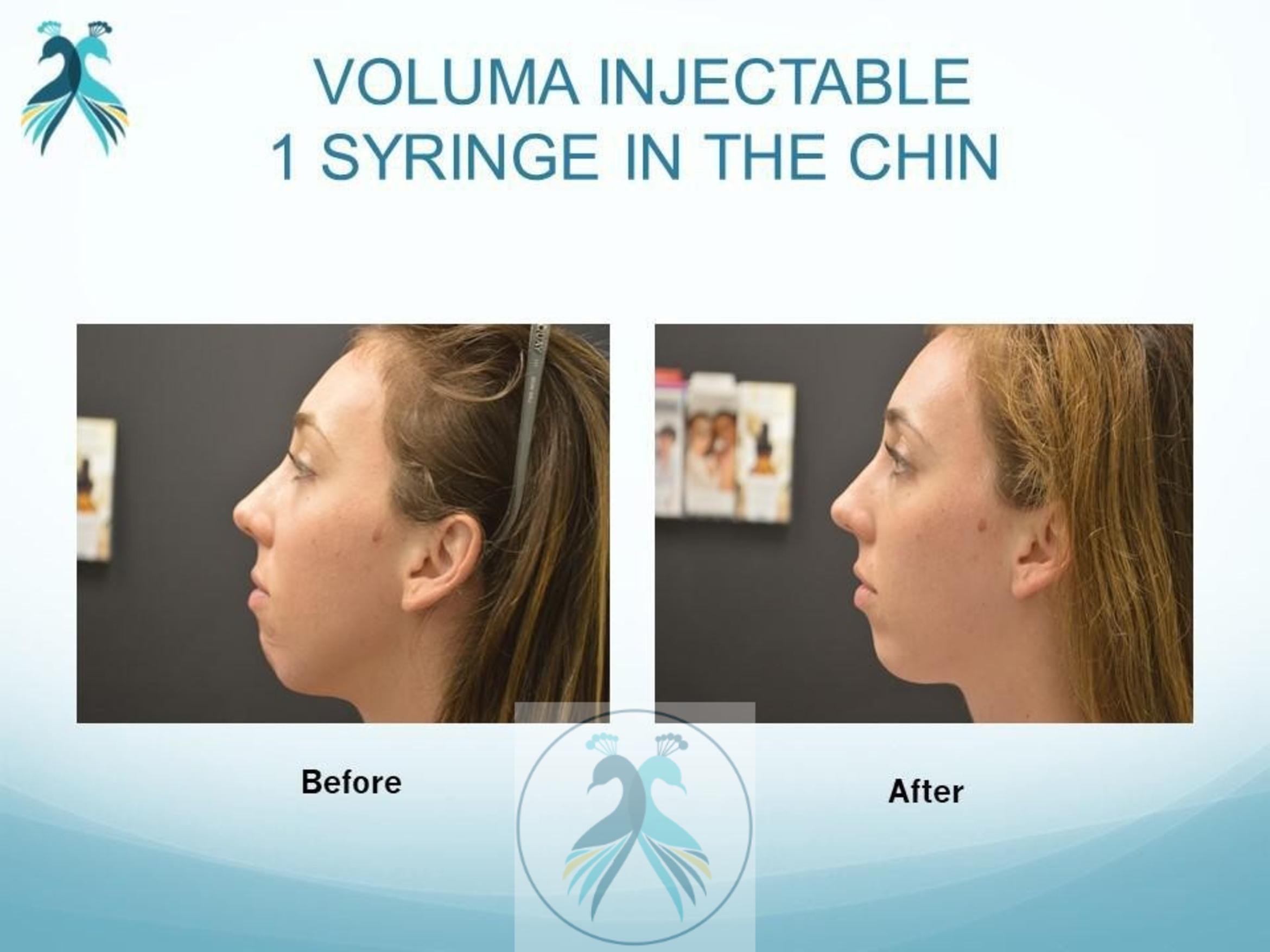 Before & After JUVÉDERM® Dermal Fillers Case 23 View 1 View in The Woodlands, TX