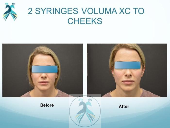 Before & After JUVÉDERM® Dermal Fillers Case 24 View 1 View in The Woodlands, TX
