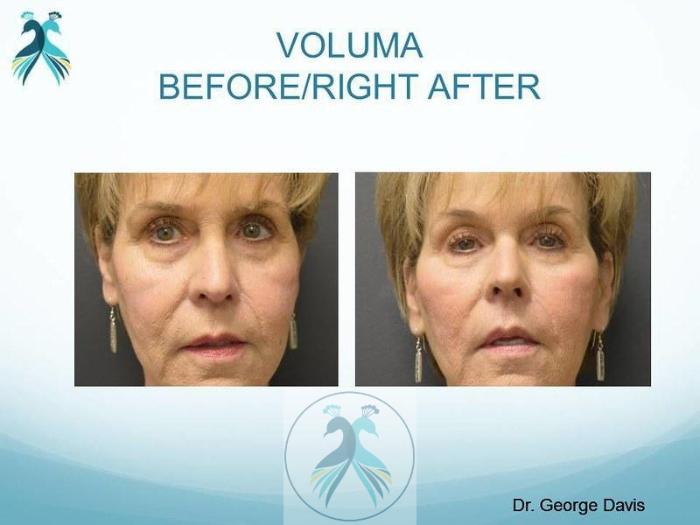 Before & After JUVÉDERM® Dermal Fillers Case 25 View 1 View in The Woodlands, TX