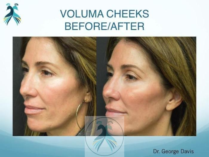 Before & After JUVÉDERM® Dermal Fillers Case 26 View 1 View in The Woodlands, TX
