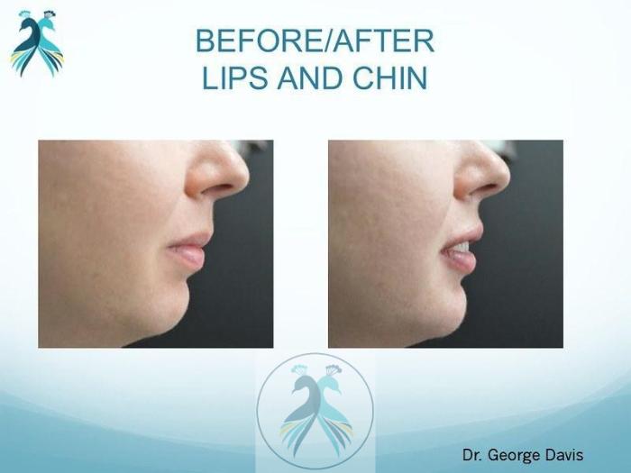Before & After JUVÉDERM® Dermal Fillers Case 27 View 1 View in The Woodlands, TX