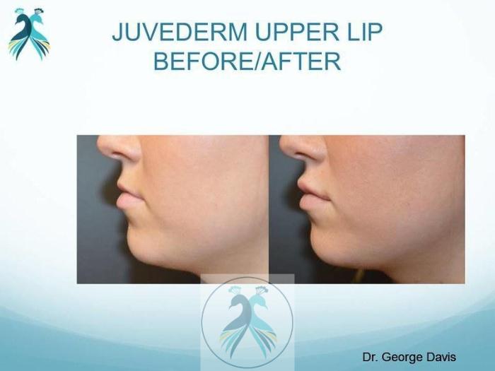 Before & After JUVÉDERM® Dermal Fillers Case 28 View 1 View in The Woodlands, TX