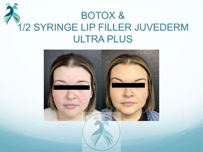 Before & After JUVÉDERM® Dermal Fillers Case 29 View 1 View in The Woodlands, TX