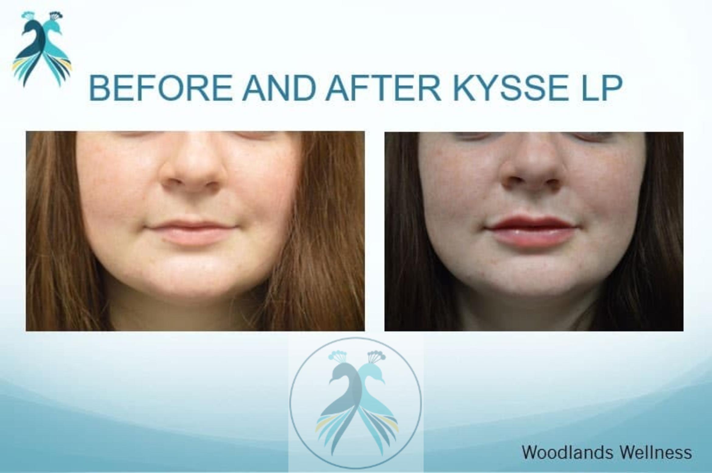 Before & After Lip Enhancement Case 36 View 1 View in The Woodlands, TX