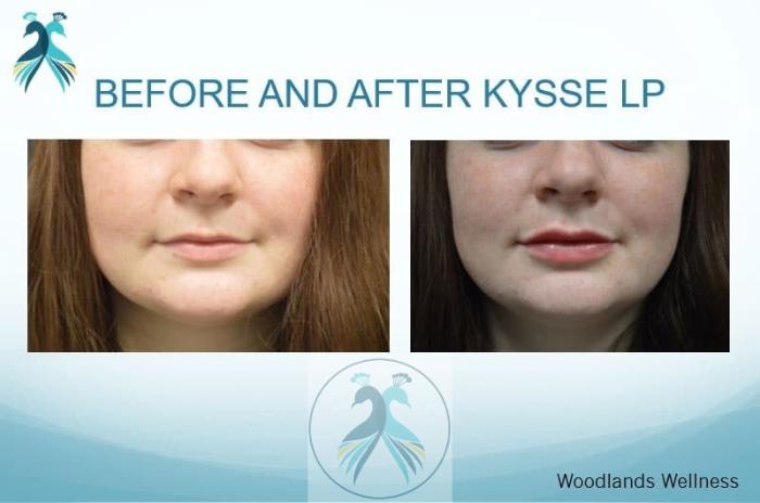 Before & After Lip Enhancement Case 36 View 1 View in The Woodlands, TX