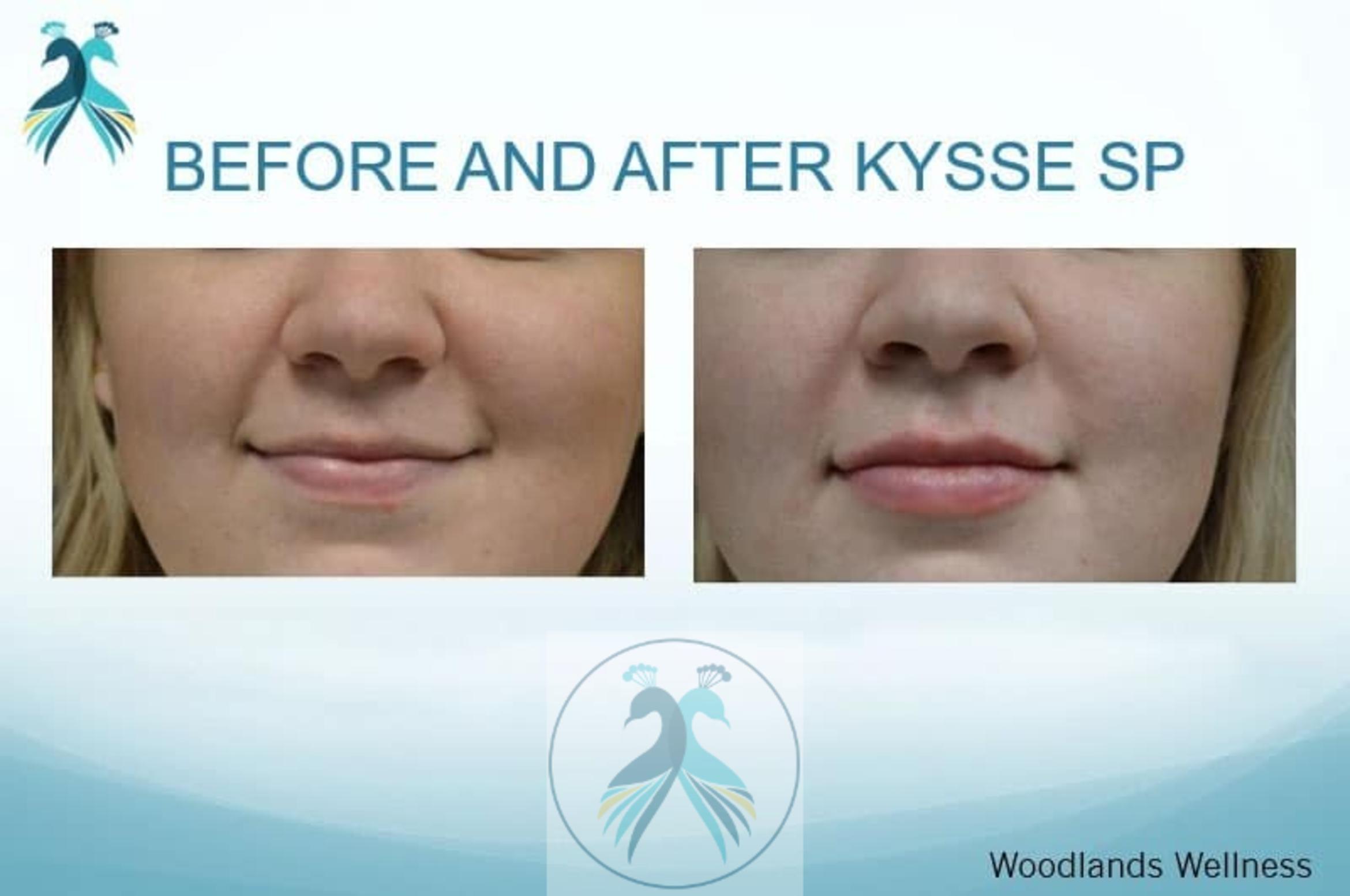 Before & After Lip Enhancement Case 37 View 1 View in The Woodlands, TX