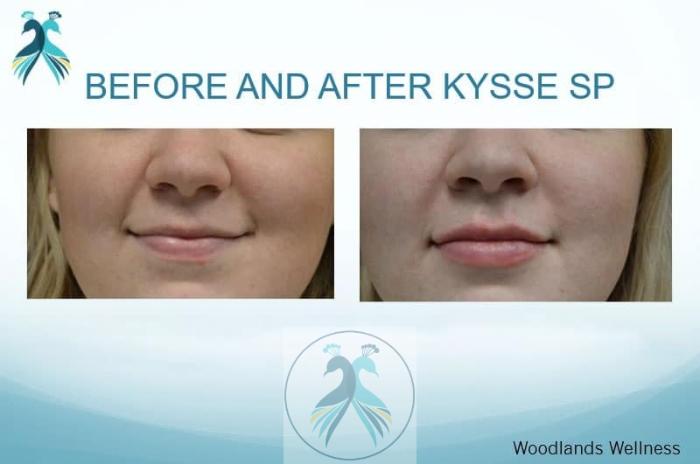 Before & After Lip Enhancement Case 37 View 1 View in The Woodlands, TX