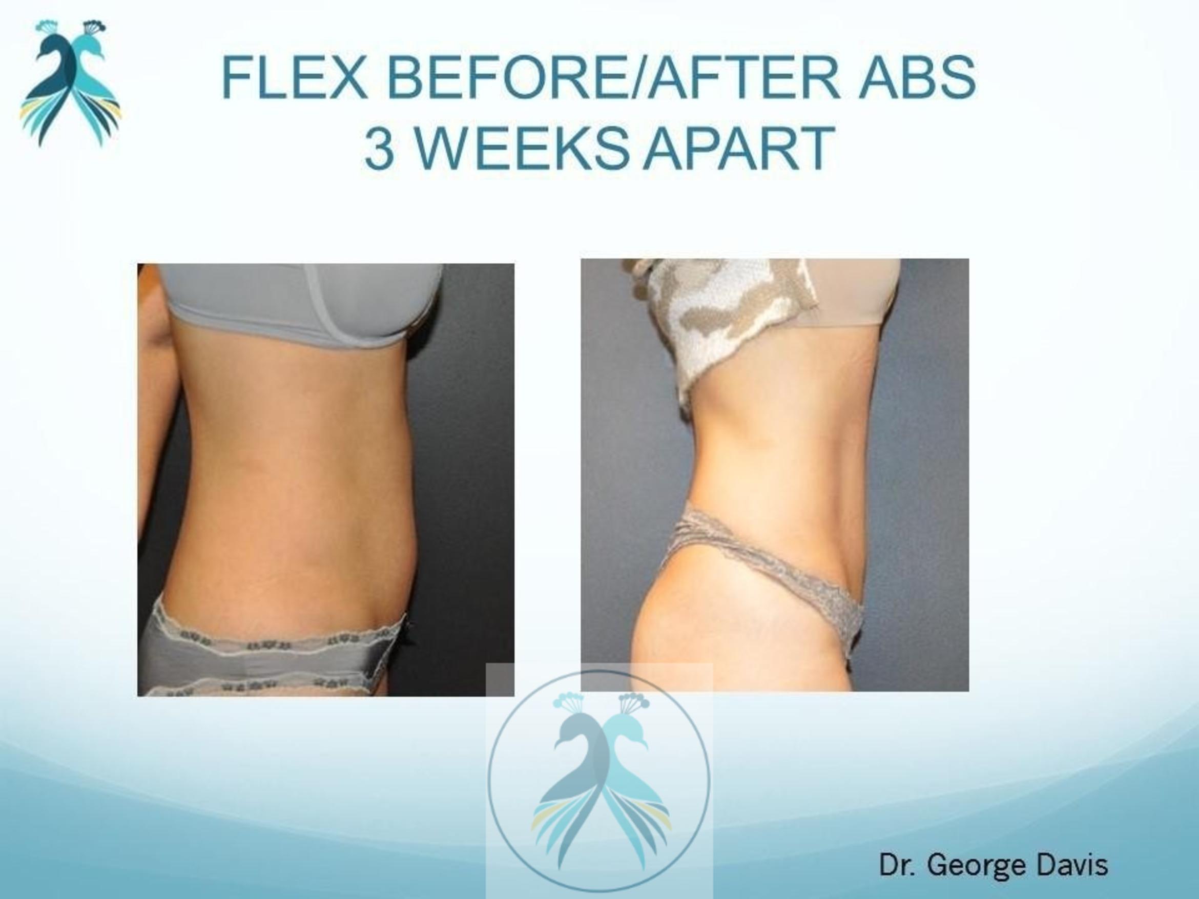 Before & After Muscle Sculpting with TruSculpt® Flex Case 55 View 1 View in The Woodlands, TX