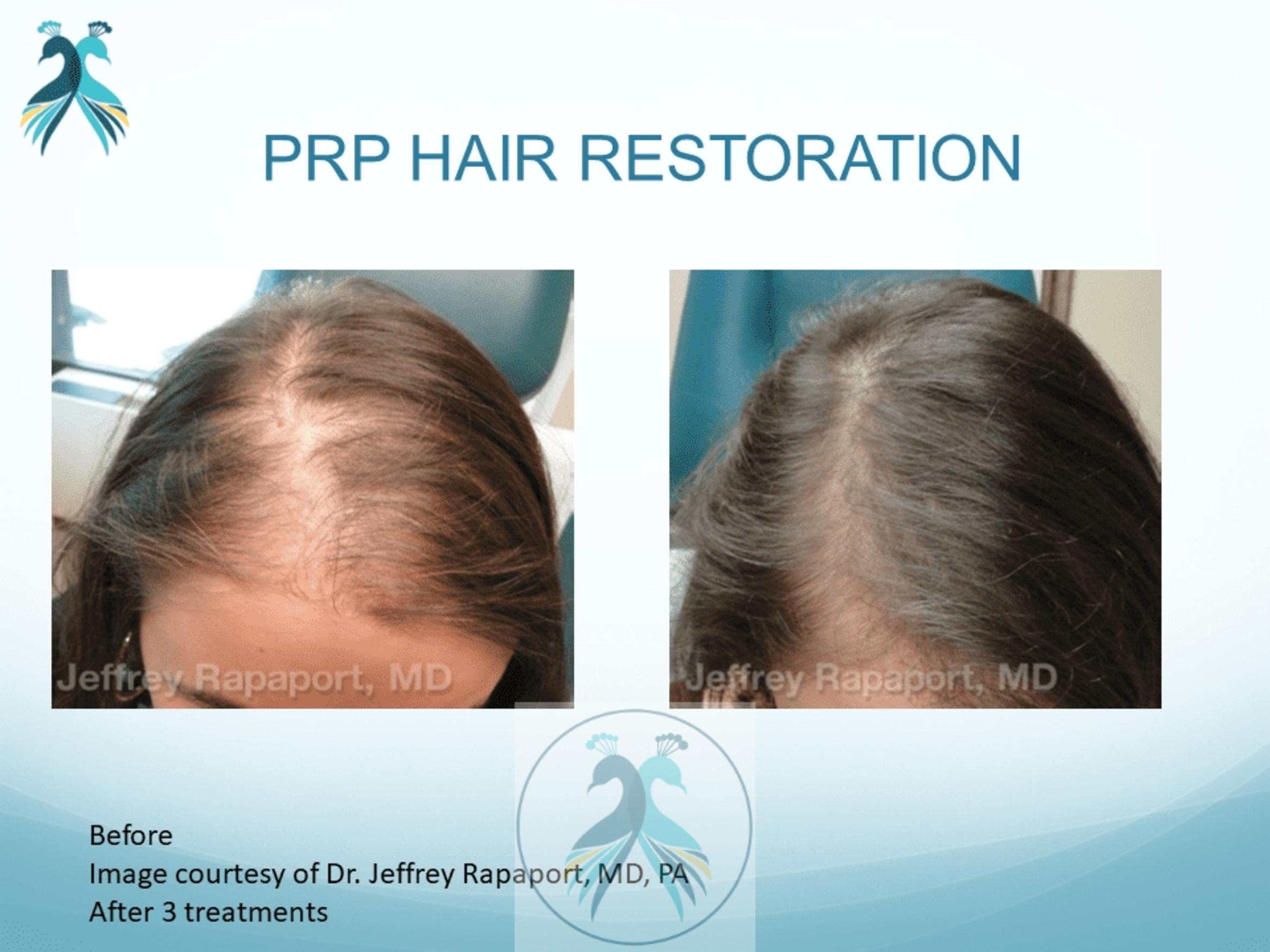 Before & After PRF Hair Restoration Case 38 View 1 View in The Woodlands, TX