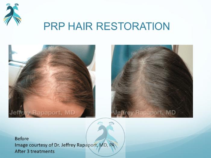 Before & After PRF Hair Restoration Case 38 View 1 View in The Woodlands, TX