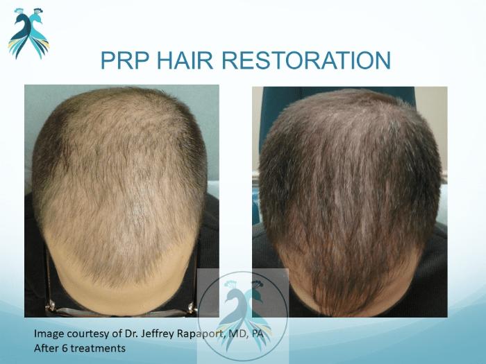 Before & After PRF Hair Restoration Case 39 View 1 View in The Woodlands, TX