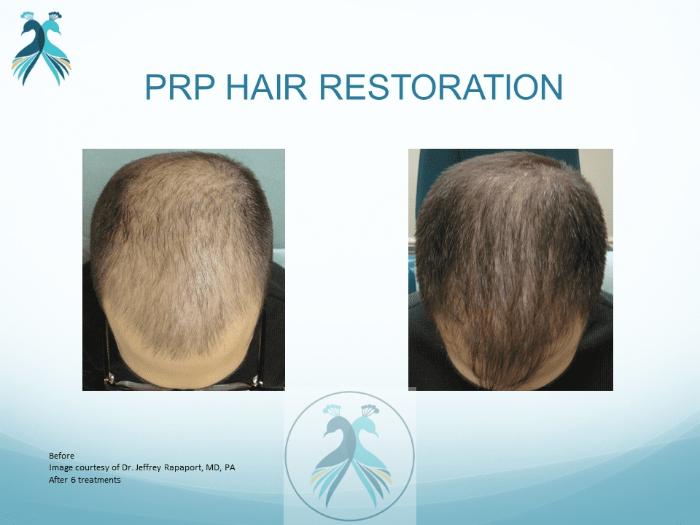 Before & After PRF Hair Restoration Case 40 View 1 View in The Woodlands, TX
