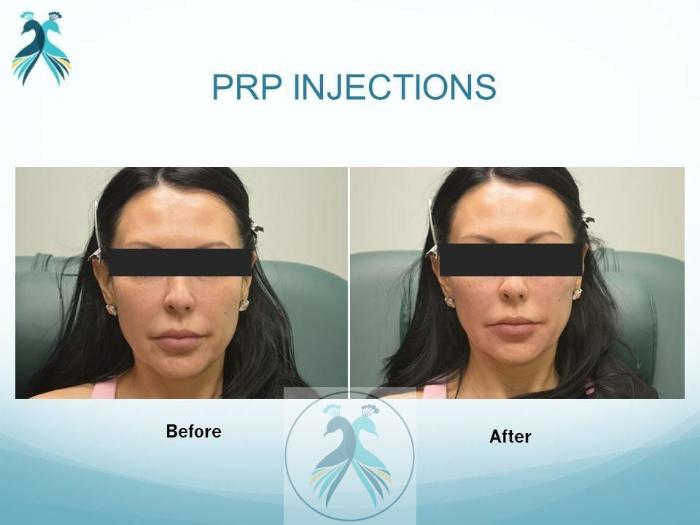 Before & After PRF Hair Restoration Case 41 View 1 View in The Woodlands, TX
