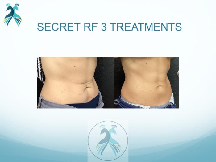 Before & After RF Microneedling Case 45 View 1 View in The Woodlands, TX