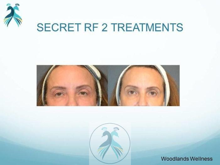 Before & After RF Microneedling Case 46 View 1 View in The Woodlands, TX