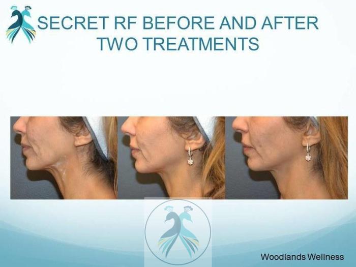 Before & After RF Microneedling Case 47 View 1 View in The Woodlands, TX