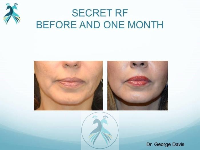 Before & After RF Microneedling Case 48 View 1 View in The Woodlands, TX