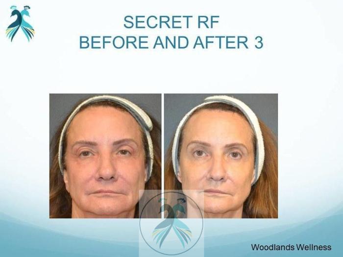 Before & After RF Microneedling Case 49 View 1 View in The Woodlands, TX