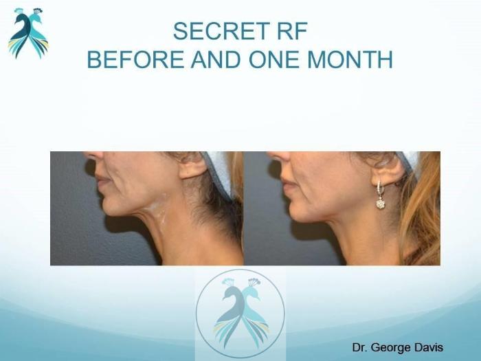 Before & After RF Microneedling Case 50 View 1 View in The Woodlands, TX